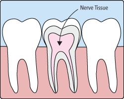 Root Canals